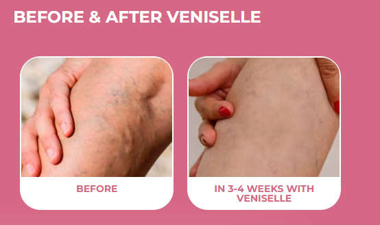 veniselle natural cream varicose veins horse chestnut extract ingredients spider veins cream