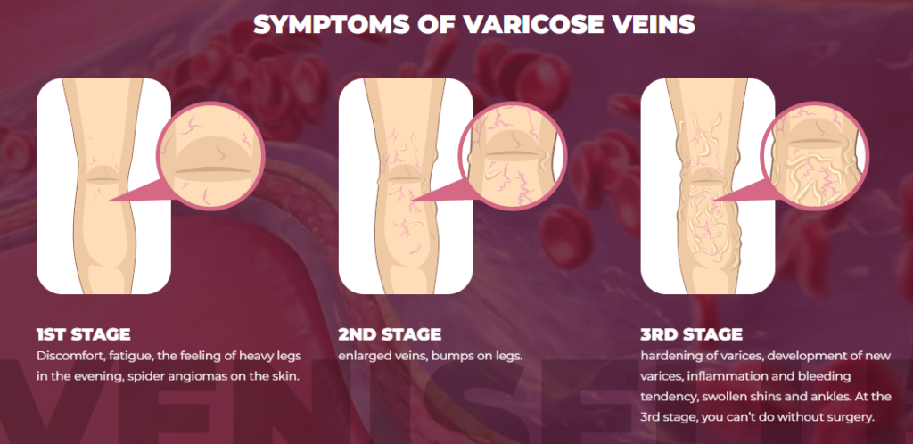veniselle cream for legs before after results varicose veins pain relief cream